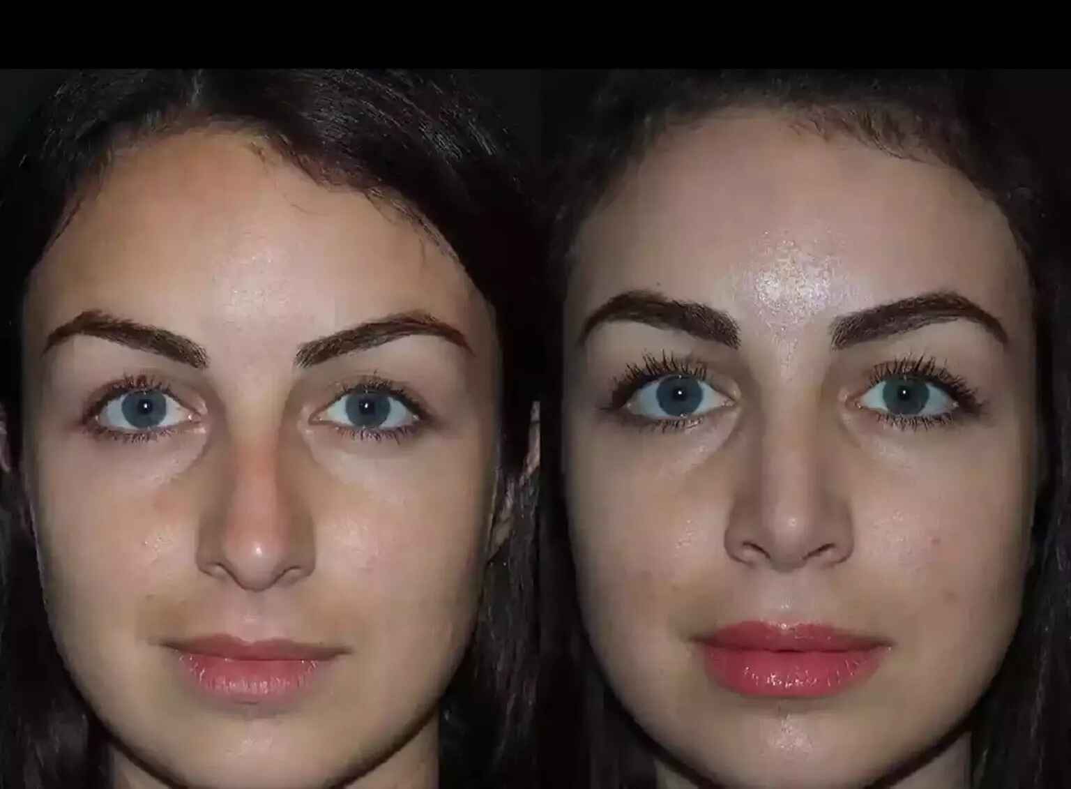 Rhinoplasty in Dubai: Your Path to Facial Confidence