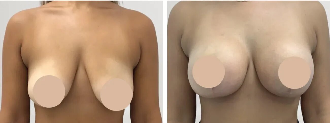 Best Doctors in Dubai Guide You to Perfect Shape with Breast Reduction