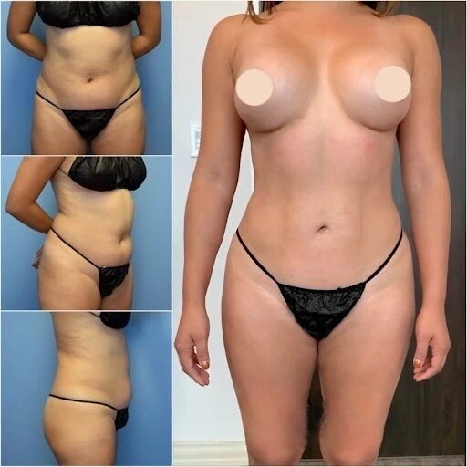 Body Contouring in Dubai: Most Requested Procedures