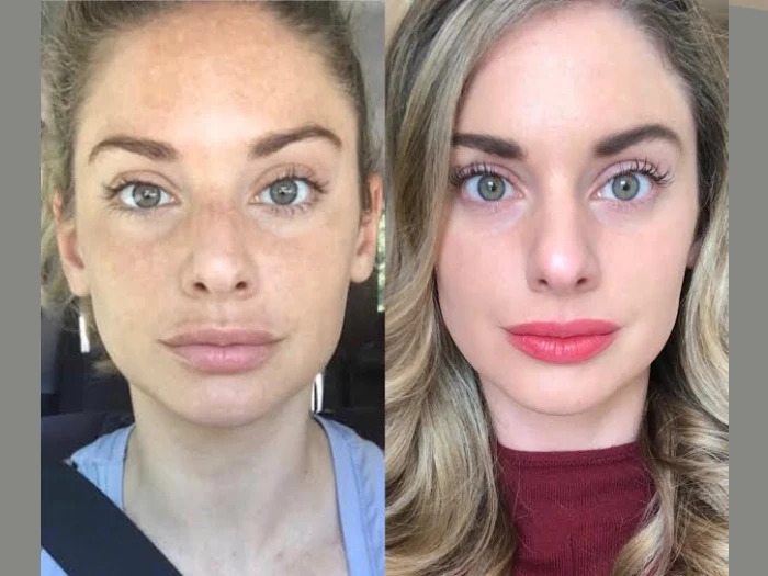 Radiofrequency (RF) Microneedling Treatment in Dubai for Skin Firmness and Glow