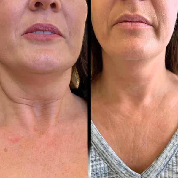 Why Do Patients Prefer the Best Doctors in Dubai for Profhilo?