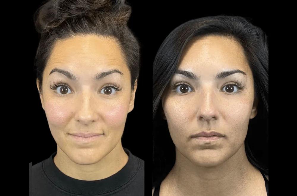 How Botox Treatments in Dubai Help Boost Confidence and Self-Esteem