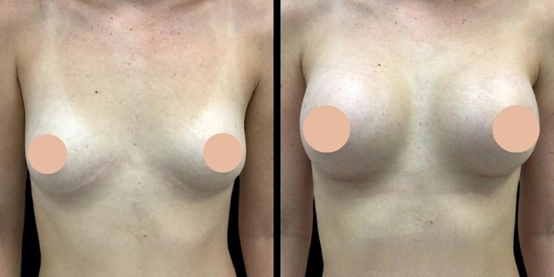 Breast Augmentation in Dubai: Celebrity Trends and Popular Styles