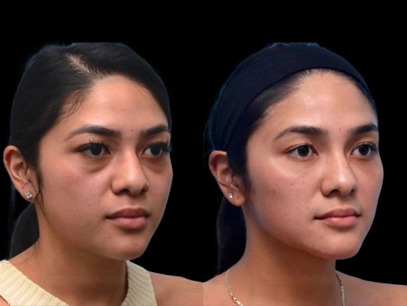 PRP Therapy for Dark Circles by the Best Plastic Surgeon in dubai