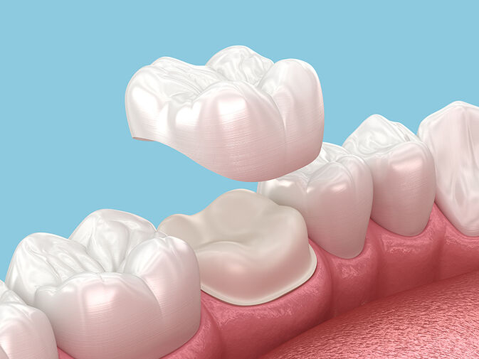 Dental Crowns and Bridges Dubai: Durable Solutions for Missing Teeth
