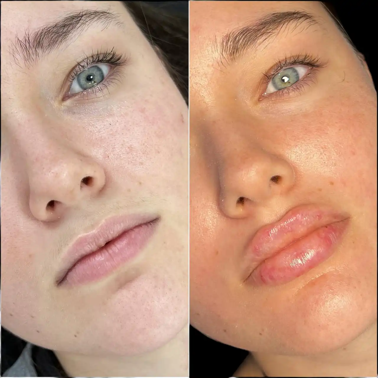 Best Doctors in Dubai for Fillers for Full Facial Harmony