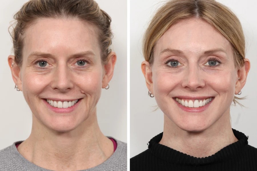 Your Guide to Thread Lift with the Best Doctors in dubai