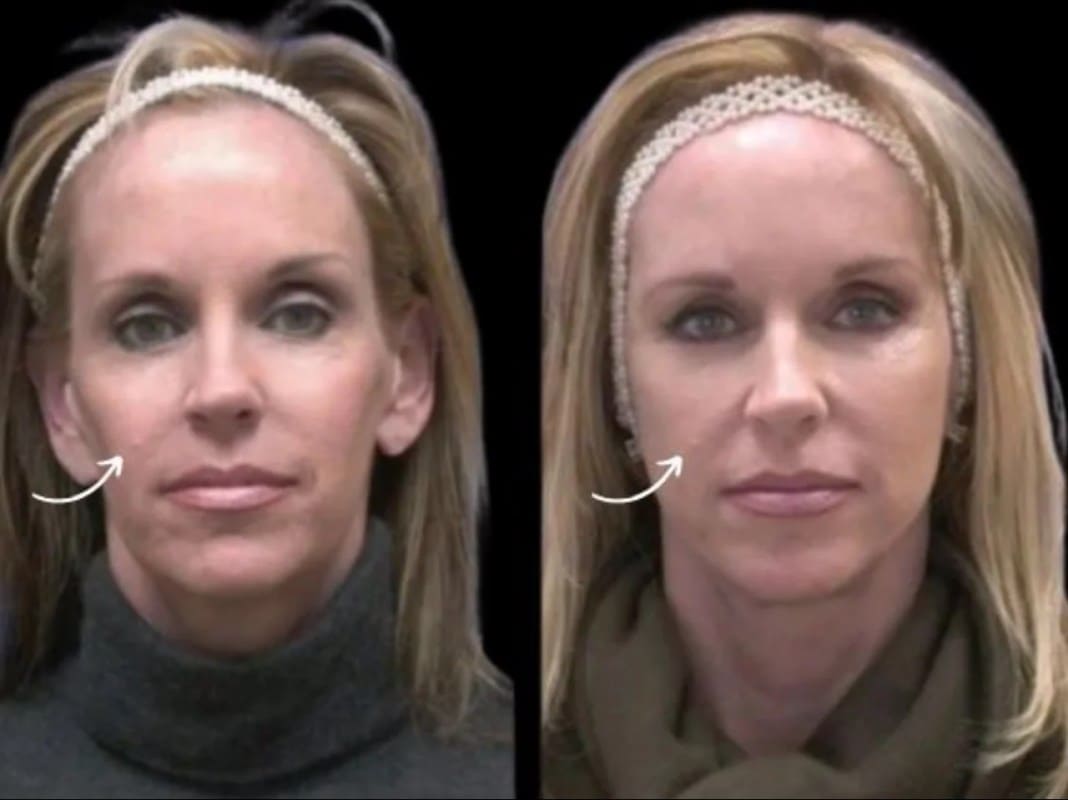 Sculptra Fillers Basics by Best Plastic Surgeon in Dubai