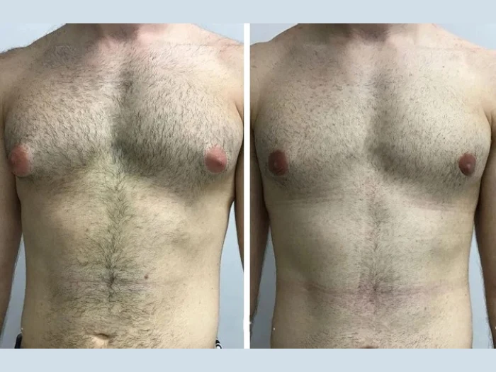 How the Best Gynecomastia Surgeons in dubai Plan Personalized Treatment