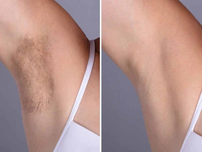Best Doctors in dubai: Laser hair removal with Minimal Downtime
