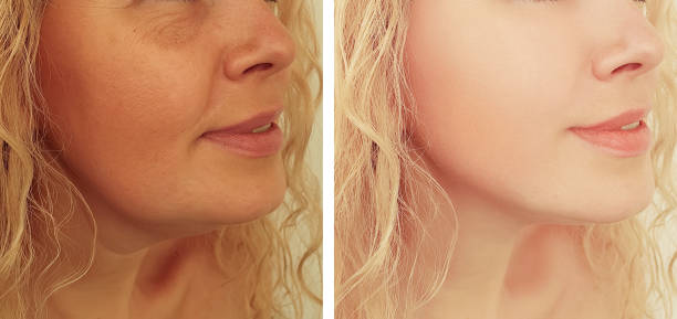 AI-Guided Fat Reduction: The Future of Double Chin Removal in Abu Dhabi