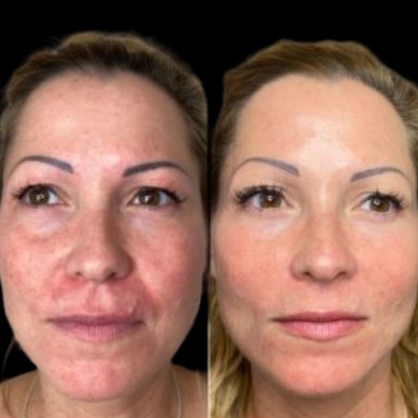 What Makes the Best Plastic Surgeon in Dubai Ideal for Profhilo?